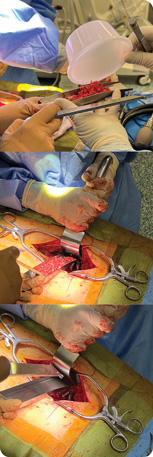Harvey Lumbar Bone Graft Sled Assembly