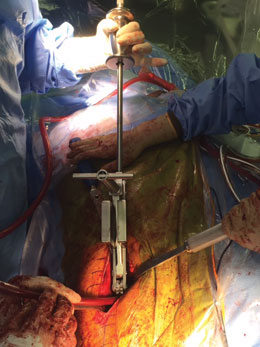 Heck Anterior Modular Hip Component Extractor with Strikeplate