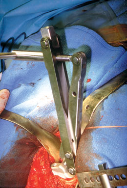 Universal Modular Femoral Hip Component Extractor