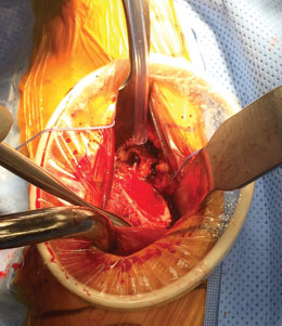 Hope Direct Anterior Femoral Retractor