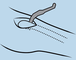 Hope Direct Anterior Femoral Retractor