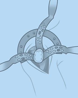Horseshoe Shoulder Frame and Blade Assembly