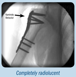 Kaminsky OrthoLucent™ Browne-type Deltoid Retractors