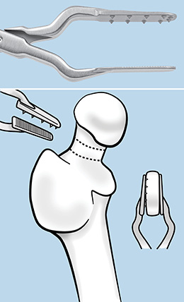 Kenerly Double Parallel Femoral Neck Disc Grasper