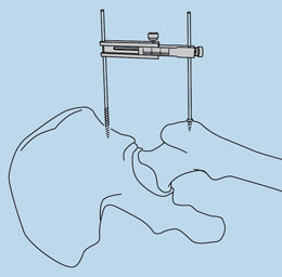 Koonin Short Length Caliper
