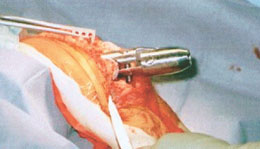 Sheffield Universal Prosthetic Elbow Extraction System
