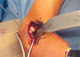 Lateral Condyle Fracture Set