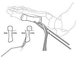 Lee MIS Bunion Parallel Guide