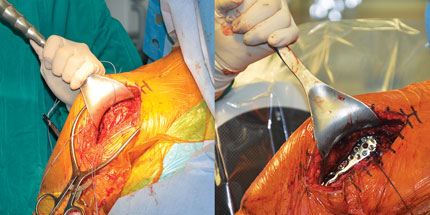 Levy Wide Deltoid Retractor