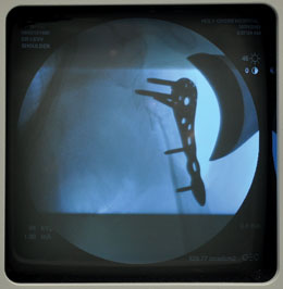 Levy Wide Deltoid Retractor