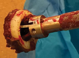 Lombardi Hip Cup Liner/Shell Extractor
