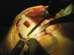 Lombardi Tibia Cement Preparation Drill