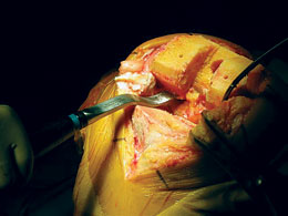 Lotke Offset Osteotome