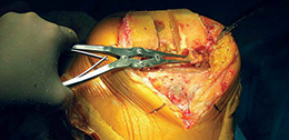 Lotke Double Action Cartilage Graspers