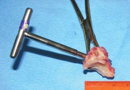Lubahn Carpal Corkscrew
