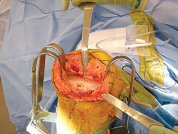 MIS PCL Retractor