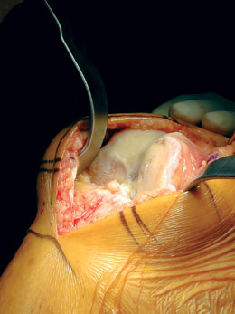 MIS Patella Retractor