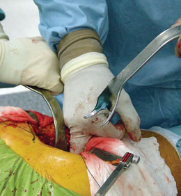 Minimal Incision Total Hip Retractors