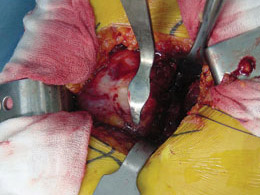 Minimal Incision Total Hip Retractors