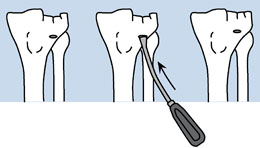 Malleable Bone Tamps