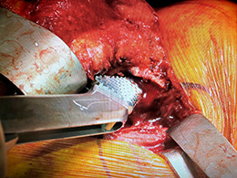 McMaster Abductor Retractor