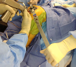 McPherson Retractor Extender