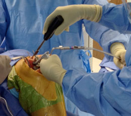 McPherson Retractor Extender
