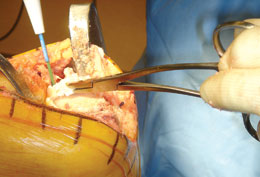 Meniscal Clamp 