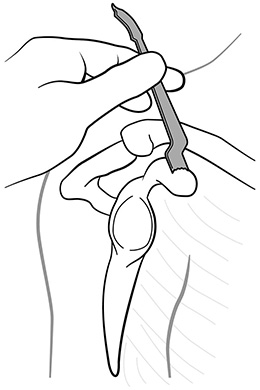 Superior Coracoid Retractor