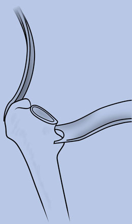 ABLE Advanced Anterior Approach Set