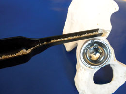 Namba Bone Graft Slide