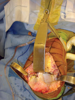 MIS Modified Wide PCL Retractor