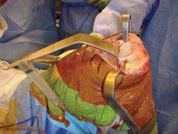 MIS Modified Wide PCL Retractor