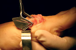 O’Brien Osteotomy Guide