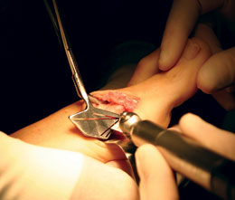 O’Brien Osteotomy Guide