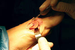 O’Brien Osteotomy Guide