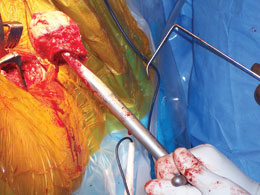 O’Reilly Femoral Head Extractor