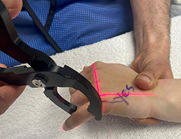 OrthoLucent™ Finger/Hand Reduction Pincers