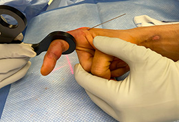 OrthoLucent™ Finger/Hand Reduction Pincers
