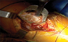 Scott Patella Resection Guide/Clamp