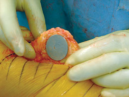 Patella Cover Plates