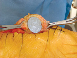 Patella Cover Plates
