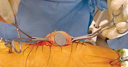 Patella Grasping Forceps