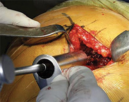 Penenberg Gluteus Retractors