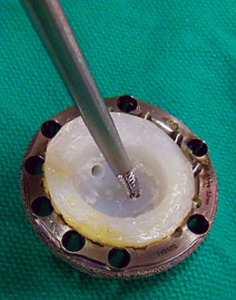 Poly Cup Liner Removal Drill