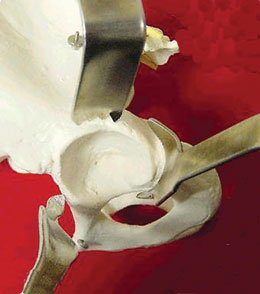 Posterior-Inferior Retractors