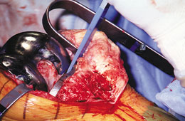 Femoral Tibial Coated Spreader Bar