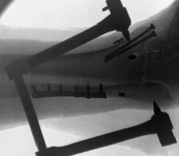 Ratcheting Reduction Clamp Assembly