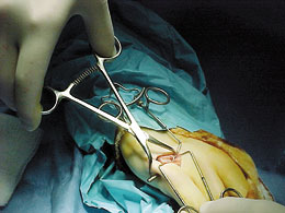 Redler Percutaneous Pin Clamp