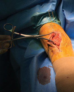 Redler Wrist Bone Clamp with Wire Guide